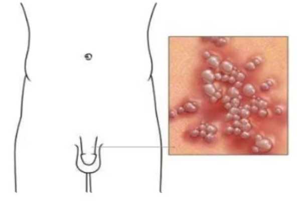 下面长疱疹怎么回事（下面长疱疹怎么办）