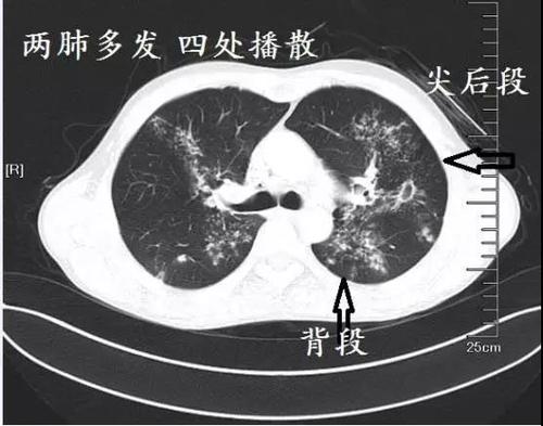 ct如何判断肺结核和肺炎