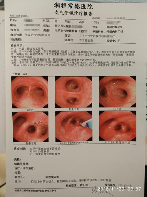 湘雅可以治疗肺结核吗